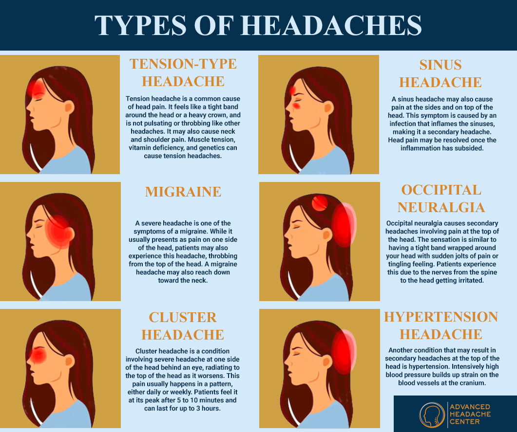 Các loại đau đầu: Migraine, Tension headache, Cluster headache
